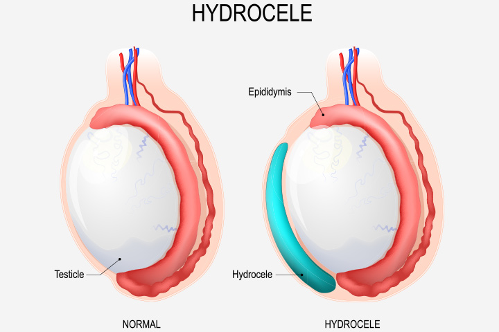 Hydrocele-In-Newborns-Causes-Symptoms-And-Treatment-Web