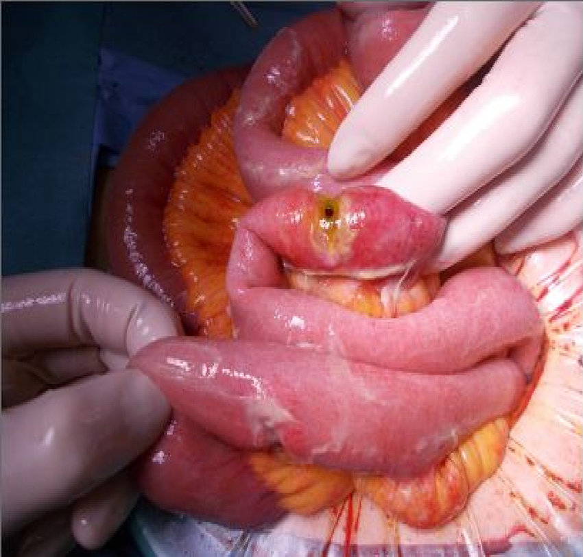 Intraoperative-findings-showed-the-perforated-surface-of-the-small-intestine-ulcer