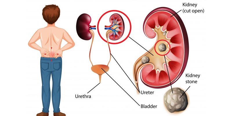kidney-stones-treatment