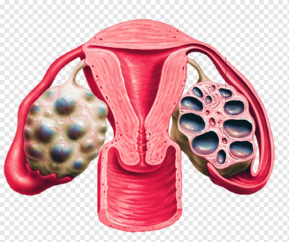 png-transparent-polycystic-ovary-syndrome-ovarian-cyst-disease-surgical-tools-disease-androgen-ovarian-cyst